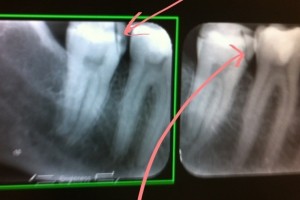 Bite Guard: Is Root Canal Therapy The Right Treatment?