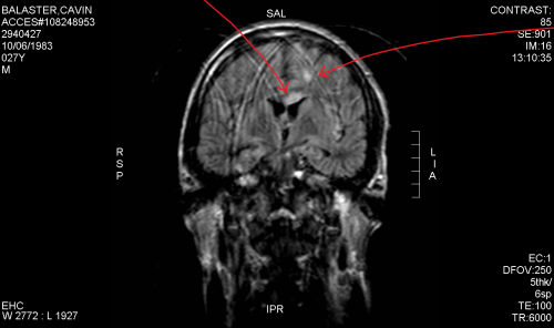 MRI scan with arrows pointing at shearing of the corpus callosum, a Diffuse Axonal Injury.