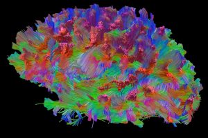 My Upcoming Brain Scan with High Definition Fiber Tracking