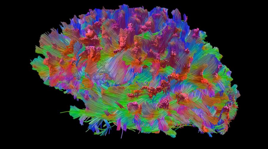 My Upcoming Brain Scan with High Definition Fiber Tracking